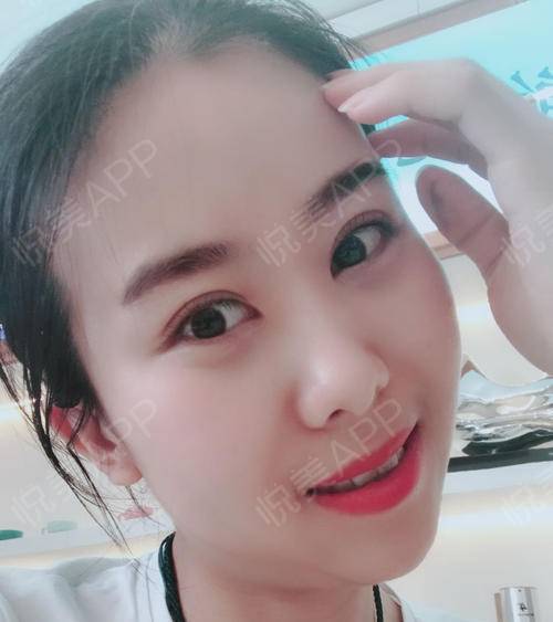 眼睛一點(diǎn)點(diǎn)恢復(fù)，越來越好看 眼部多項(xiàng)手術(shù)的蛻變之旅